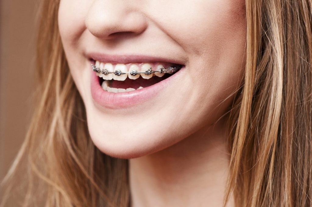 Braces Braces